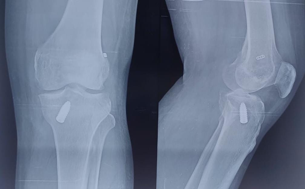 ACL Reconstruction - Treatment result by Dr. Karthik Manchala