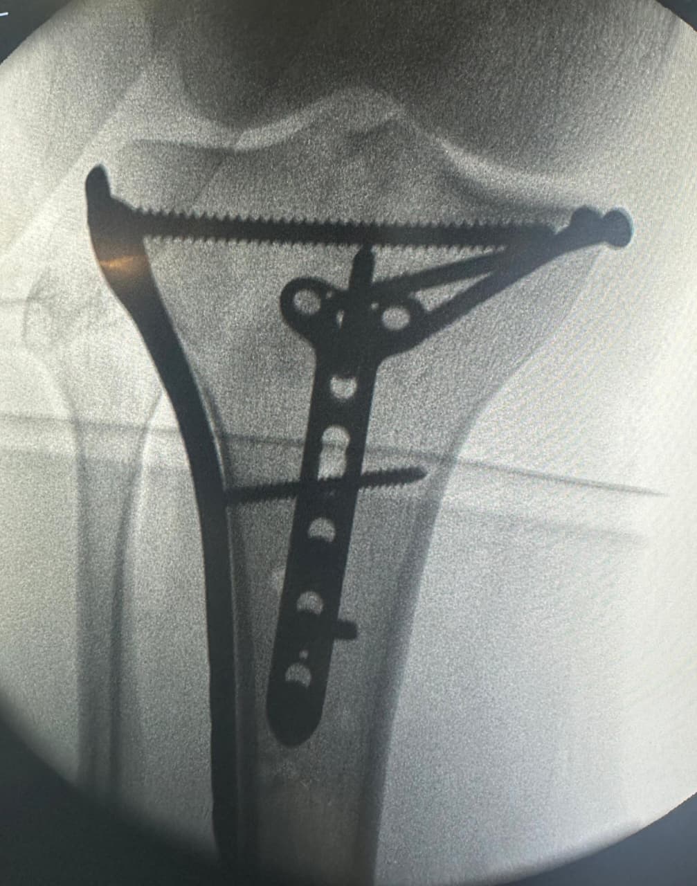Fracture Fixation - Treatment result by Dr. Karthik Manchala